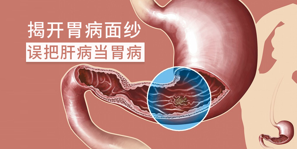 警惕“假胃病”，小心是肝有問題