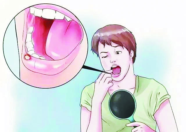 口腔潰瘍不是只需要補(bǔ)充維生素C，它們也是必不可少